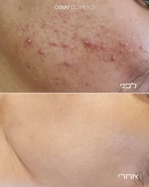 לפני ואחרי טיפול באקנה